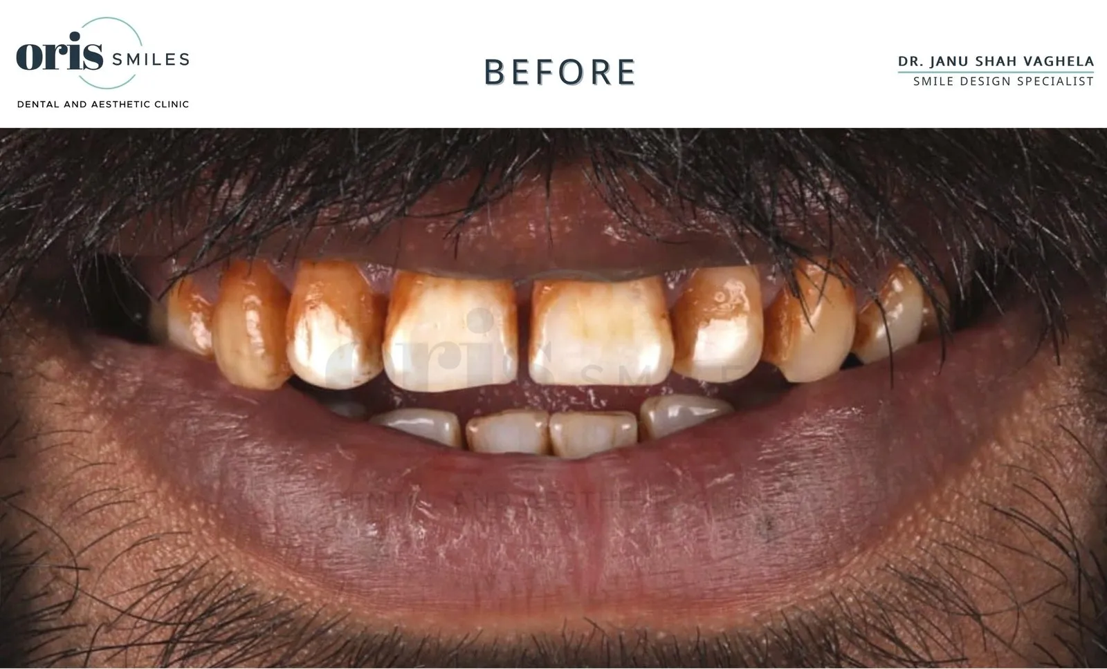 Smile transformation before and after case 1 at Oris Smiles