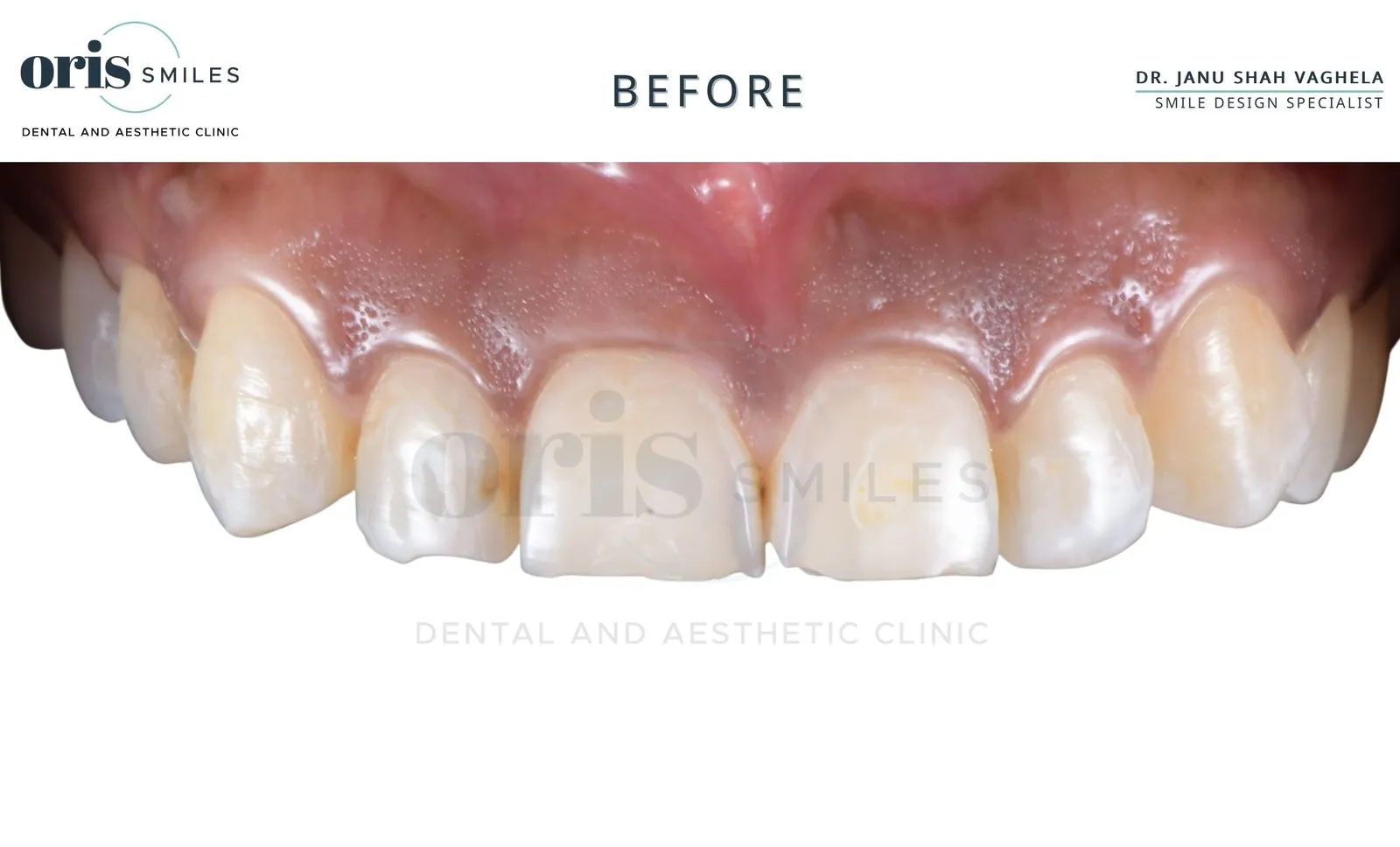 Smile transformation before and after case 11 at Oris Smiles
