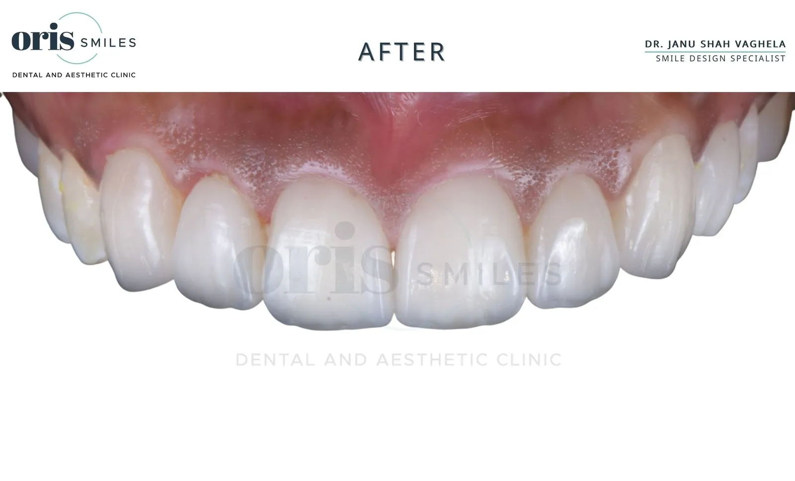 Smile transformation before and after case 12 at Oris Smiles