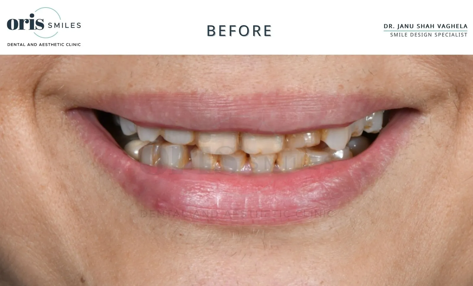 Smile transformation before and after case 13 at Oris Smiles