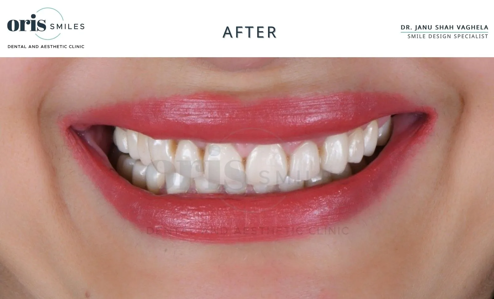 Smile transformation before and after case 14 at Oris Smiles