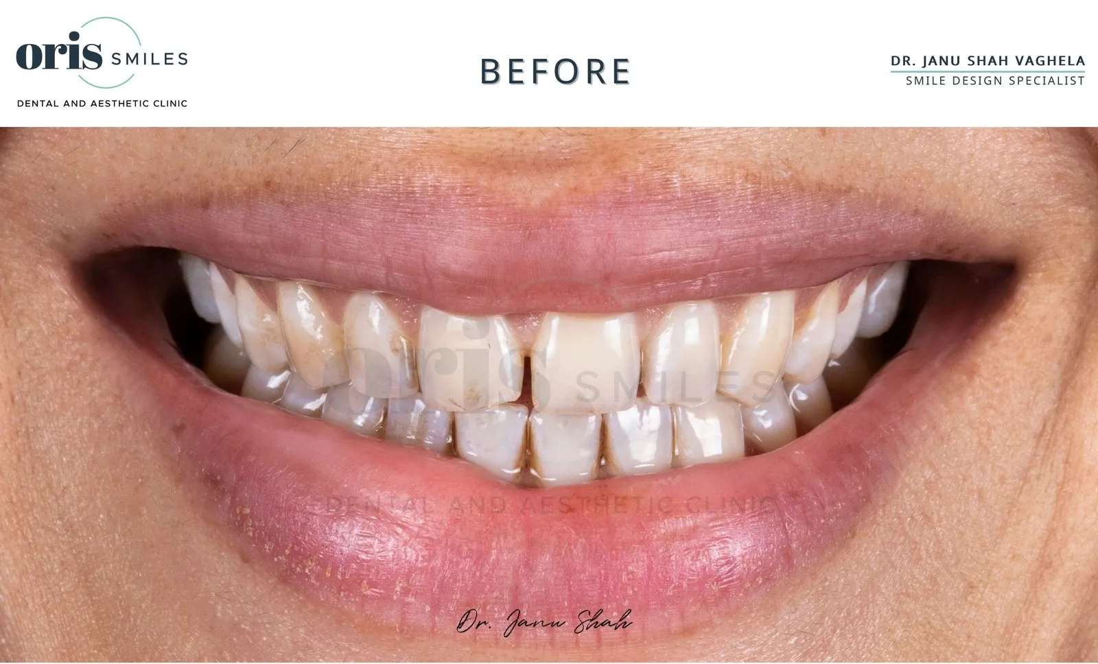 Smile transformation before and after case 17 at Oris Smiles
