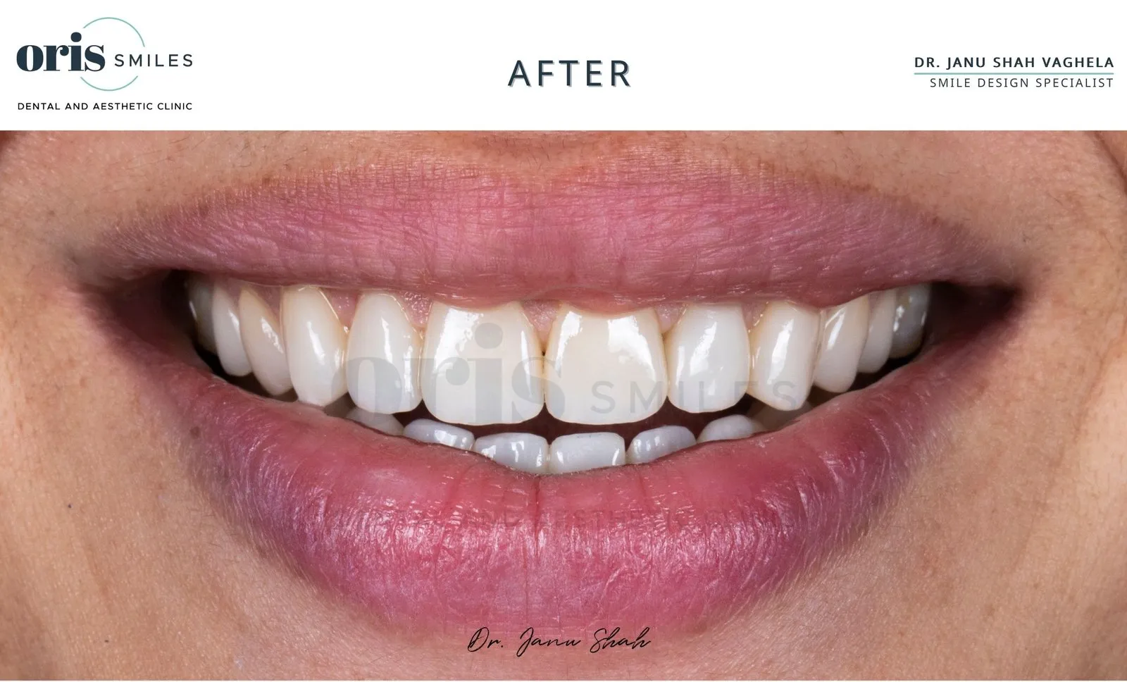 Smile transformation before and after case 18 at Oris Smiles