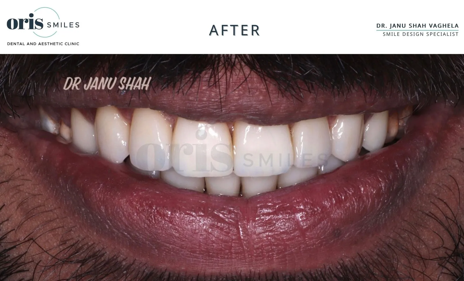 Smile transformation before and after case 2 at Oris Smiles