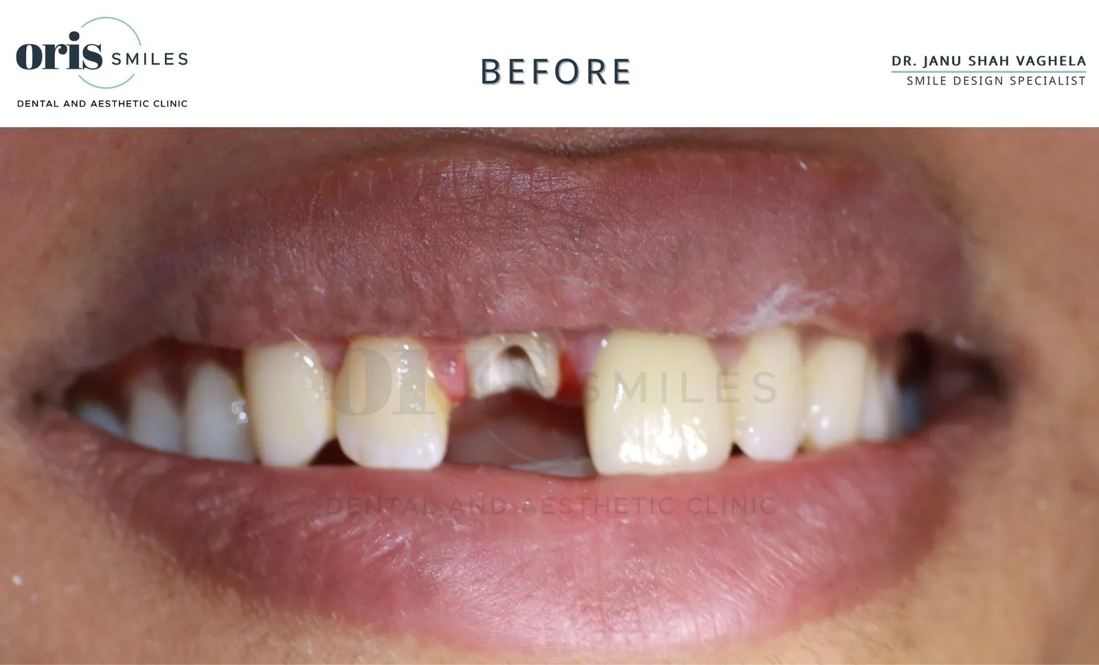 Smile transformation before and after case 21 at Oris Smiles