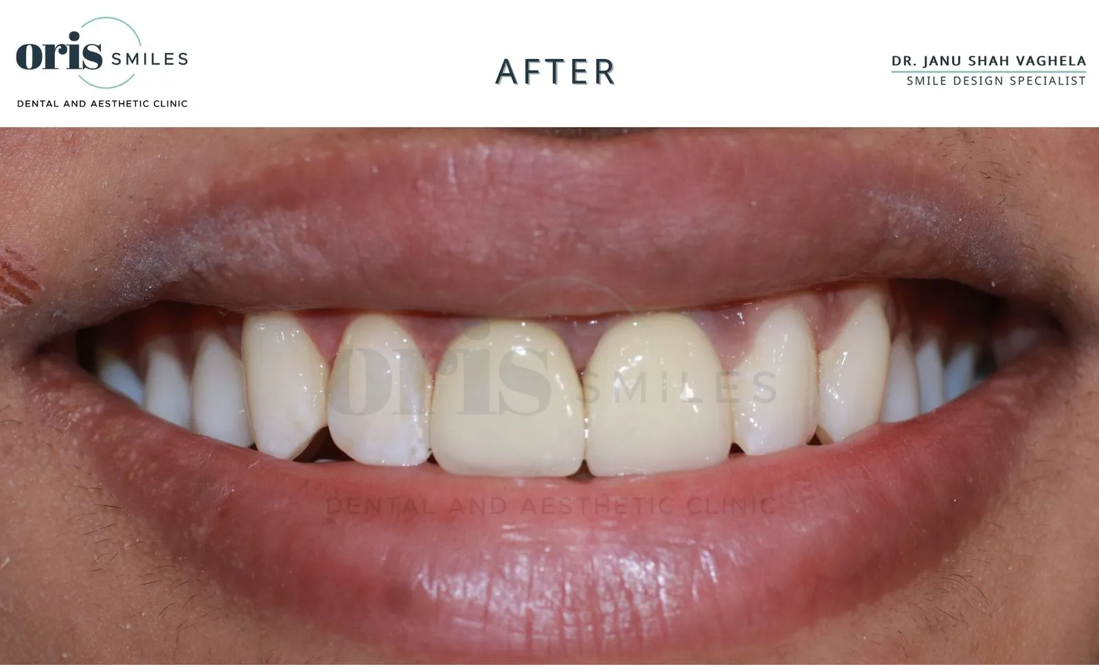 Smile transformation before and after case 22 at Oris Smiles