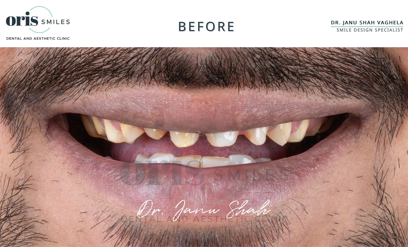 Smile transformation before and after case 425 at Oris Smiles