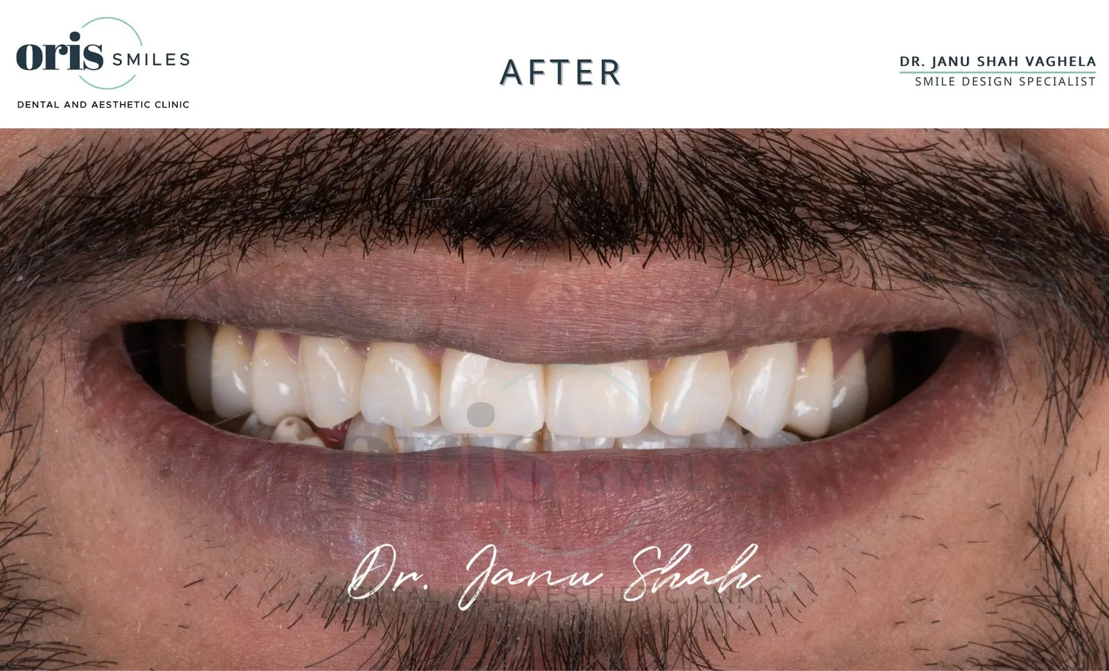 Smile transformation before and after case 426 at Oris Smiles
